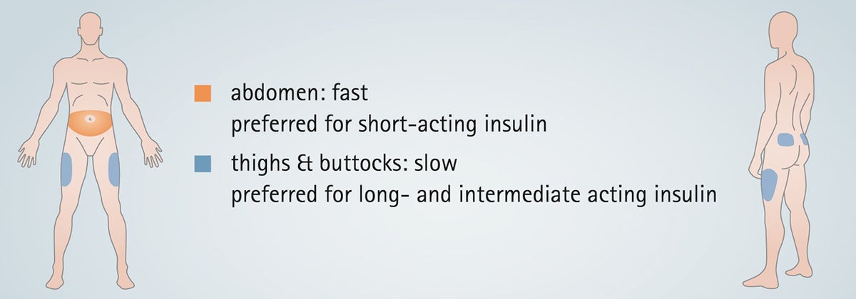 Insulin types and injection areas