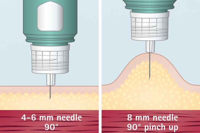 Choice of needle - injection technique